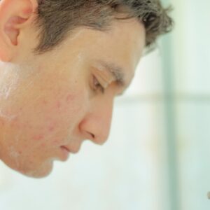 smoking weed cures acne
