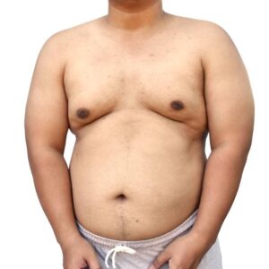 Gynecomastia Male Breast Reduction