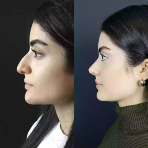 Septoplasty in dubai