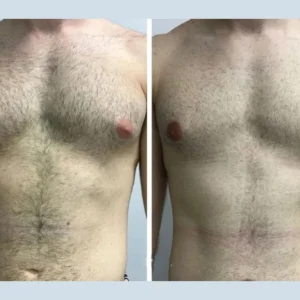 Hormonal Causes Explained by the Dr. Perfect Celebrity – The Best Gynecomastia Surgeon in Dubai