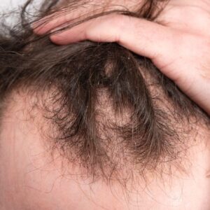 Hair Transplant in Riyadh
