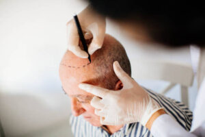 Hair transplant in Dubai
