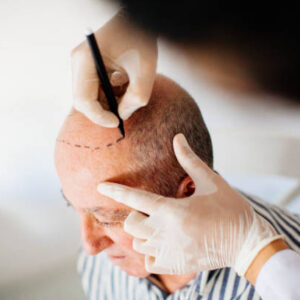 Hair transplant in Dubai