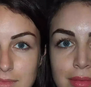septoplasty in dubai