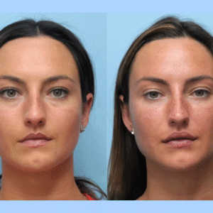 Smooth, Tight, and Radiant: Thread Lift Treatments in Dubai Explained