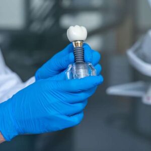 Dental Implants in Hyderabad