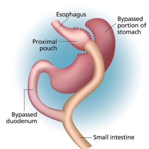 Gastric sleeve surgery singapore