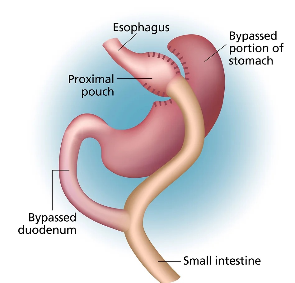 Gastric sleeve surgery singapore