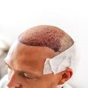 زراعة الشعر في الرياض