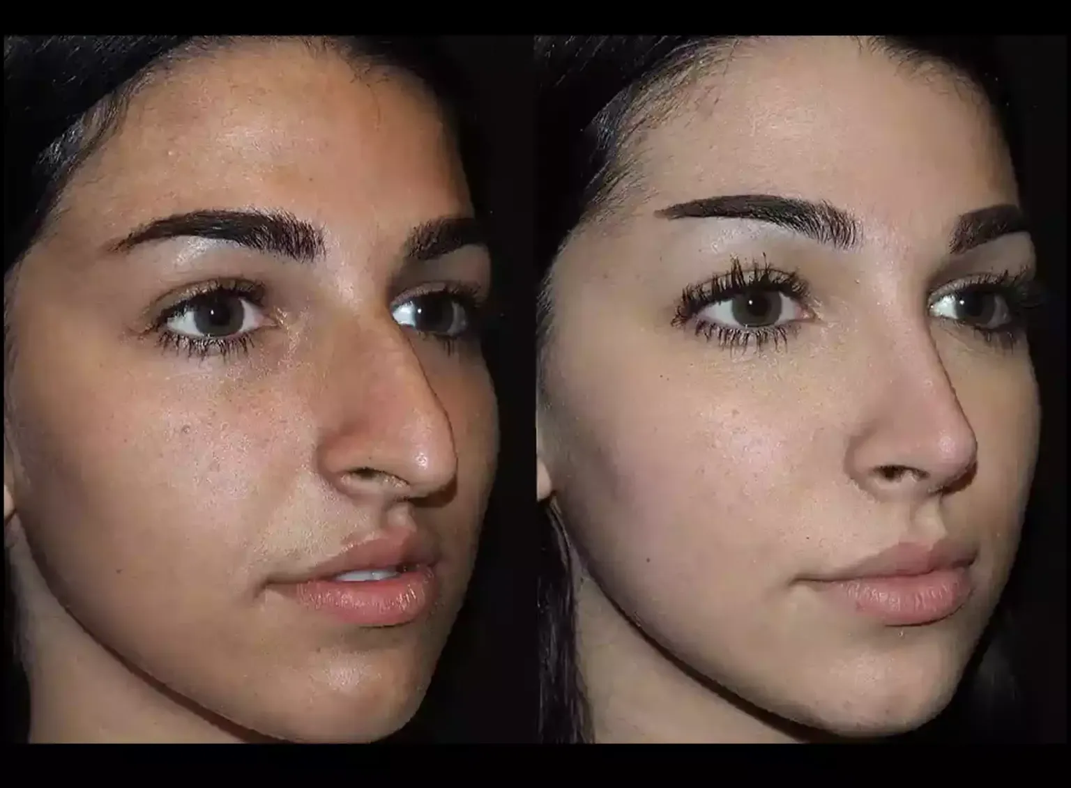 rhinoplasty in dubai