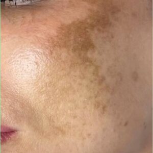 Treatment for Removing Birth Marks