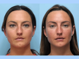 Thread Lift Treatments in Dubai for Mid-Face and Cheek Lifting