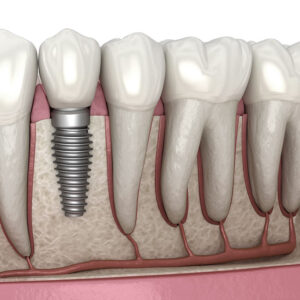 Everything You Need to Know About Dental Implants