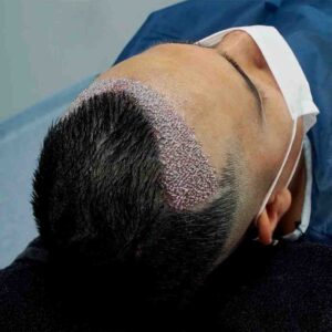 FUE Hair Transplant in Islamabad