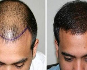 زراعة الشعر في الرياض