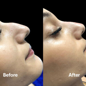 How Much Does Non-Surgical Rhinoplasty Cost?