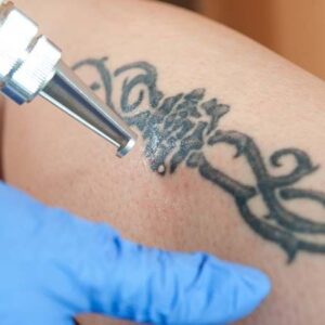 Laser Tattoo Removal
