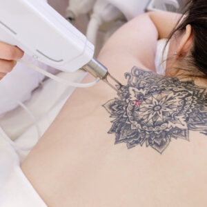Laser Tattoo Removal in Islamabad