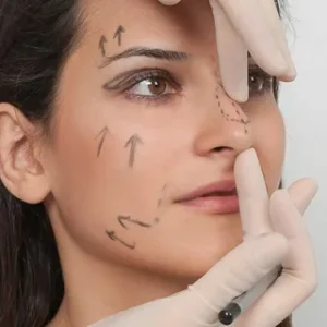 Rhinoplasty in Islamabad