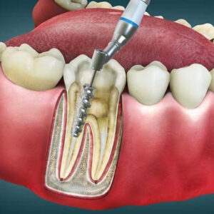 Step-by-Step Guide to a Successful Root Canal Procedure