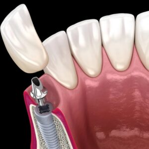 The Step-by-Step Process of Getting Dental Implants: Your Complete Guide