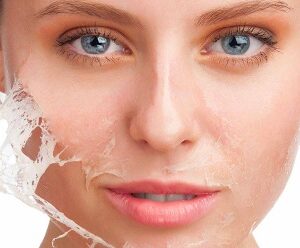 التقشير الكيميائي في الرياض