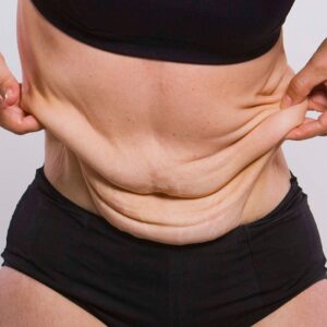 Bariatric Surgery in Islamabad