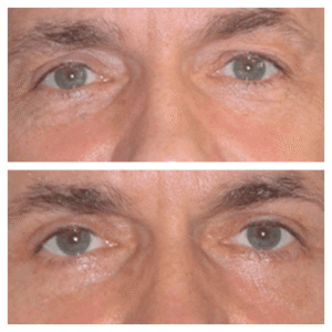 Eye Bag Removal in Dubai