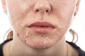 Chemical Peel in Islamabad