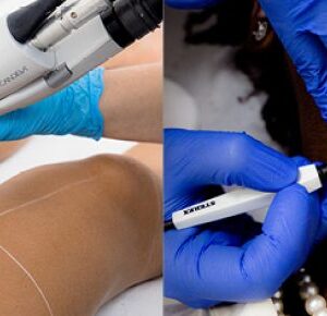 Electrolysis Hair Removal in Islamabad