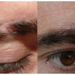 Eyebrow Hair Transplant in Islamabad