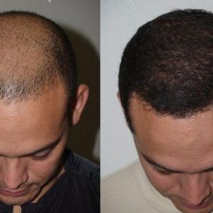 FUE Hair Transplant in Islamabad