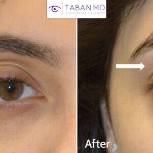 How to Fix Sunken Eyes With Fillers