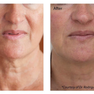 Profhilo at The Medispa: Advanced Skin Booster for Natural, Youthful Radiance