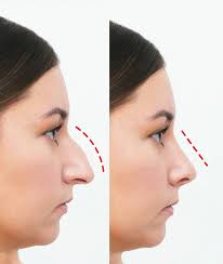 Rhinoplasty in Islamabad