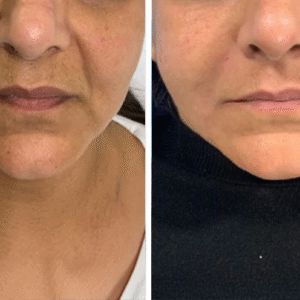 Dermal Fillers at The Medispa: Restore Volume, Define Contours, Enhance Natural Beauty