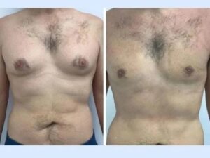 Gynecomastia in Dubai