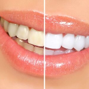 teeth whitening in islamabad
